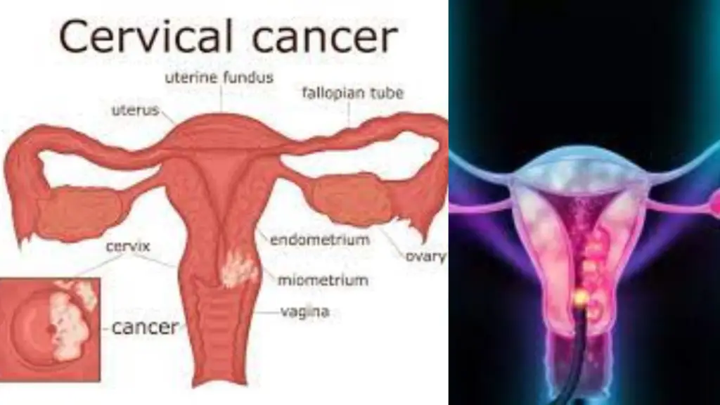 Cervical Cancer