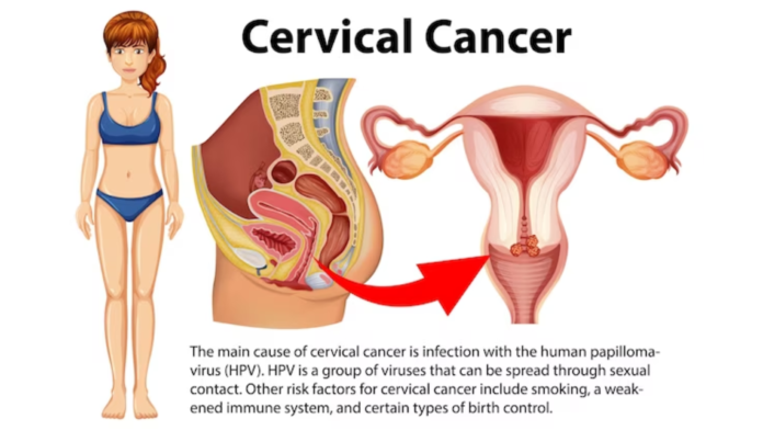 Cervical Cancer